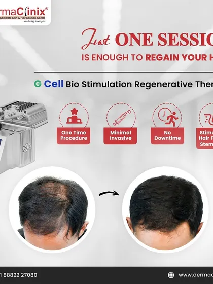 My GCell Bio Stimulation therapy is a powerful, one-time procedure for hair regeneration. This minimally invasive treatment uses your body's own cells to stimulate dormant hair follicles with no downtime, offering a significant improvement in hair density as shown in this before and after result.