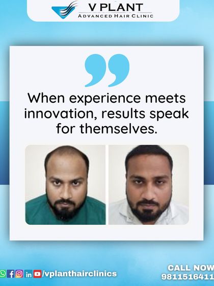 When our experience meets innovative technology, the results speak for themselves. This before-and-after comparison showcases a significant restoration of the frontal hairline and overall density.