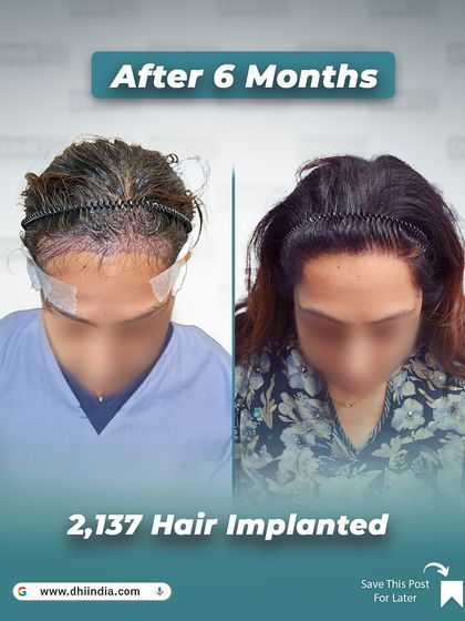 This image shows the client's head immediately after the procedure compared to the 6-month result. It provides a transparent look at the no-shave process and the incredible, confidence-restoring growth achieved.