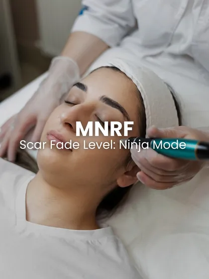 For clients looking for significant scar improvement with less downtime, I often recommend Microneedling RF, or MNRF. This procedure uses fine needles to deliver radiofrequency energy deep into the skin, triggering collagen production to repair scars from within. It is highly effective for various scar types and safe for Indian skin tones.