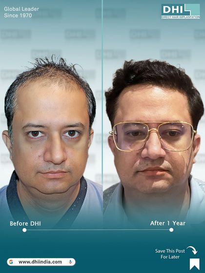 A frontal before and after comparison one year after the procedure. This image clearly shows the restored hairline and the overall change in appearance, demonstrating the lasting impact of our DHI hair transplant.