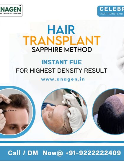 We utilize advanced methods like the Sapphire and Instant FUE techniques for those considering a transplant. A key part of this process involves using growth factors from your own blood, as shown in the vial, to achieve the highest possible density and promote healing.