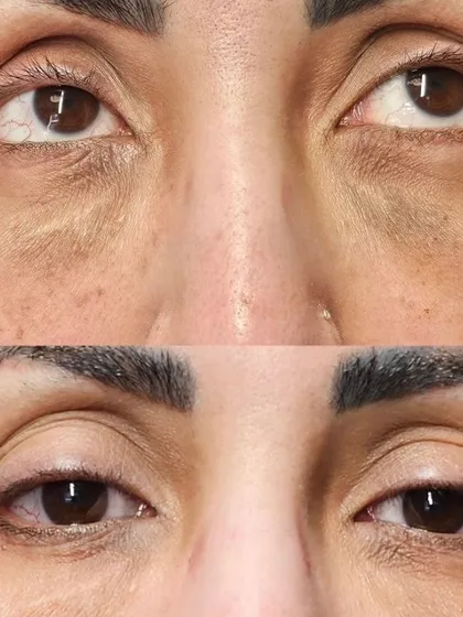 This result shows not only a lightening of dark circles but also a smoothing of fine lines and crepey texture in the under-eye area.