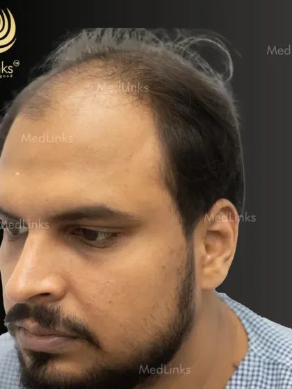 This patient's before photo shows the common 'M' shape of a receding hairline along with overall thinning. This is a classic sign of genetic hair loss that we are experts in treating.