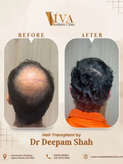 A view of the crown area for the same patient. Restoring the crown requires careful placement of grafts to mimic the natural spiral pattern of hair growth.