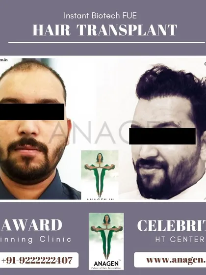 Another excellent result from our Instant Biotech FUE hair transplant. The patient's transformation is clear, with a fuller and more defined hairline.
