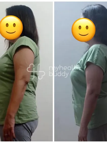 This client lost 3 kgs at the age of 48 while living a very stressful life. Her side profile shows that even small changes can lead to feeling more energetic and healthy.