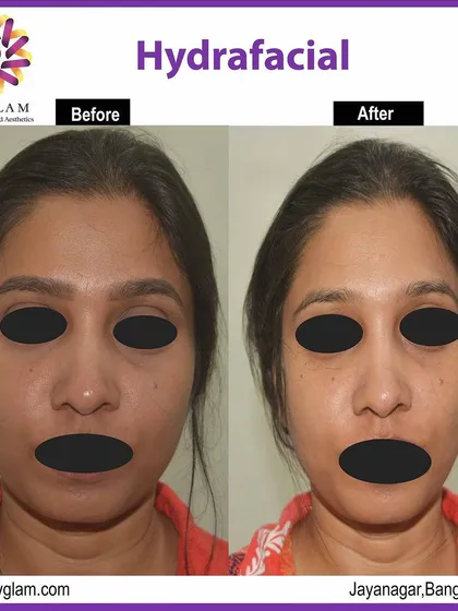 Experience an instant glow-up with our medical-grade Hydrafacial. This client's 'after' photo shows visibly brighter, more hydrated, and refreshed skin with improved tone and texture immediately following the treatment.