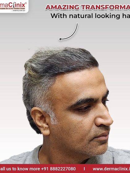 A side profile of Mr. Dhiraj's amazing transformation. This angle highlights the natural looking hairline and the density achieved, which is a hallmark of our surgical skill.