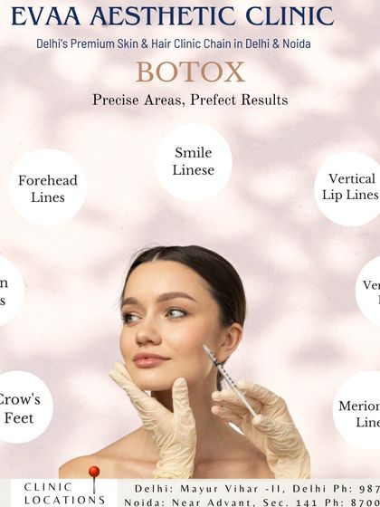 We use Botox to target precise areas for perfect results. This diagram illustrates the various facial lines we can treat, including forehead lines, crow's feet, and smile lines.
