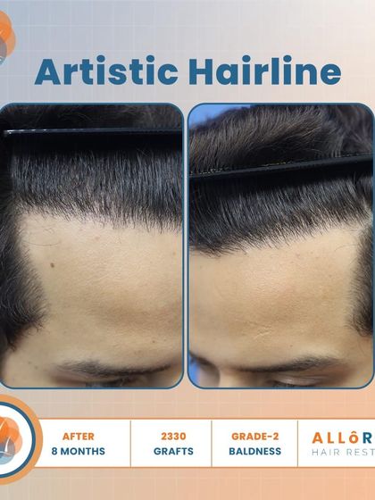 An artistic hairline is key to a natural result. This 8-month result for Grade 2 baldness, using 2330 grafts, shows how I meticulously design the hairline to be soft and irregular, avoiding a fake, pluggy look.