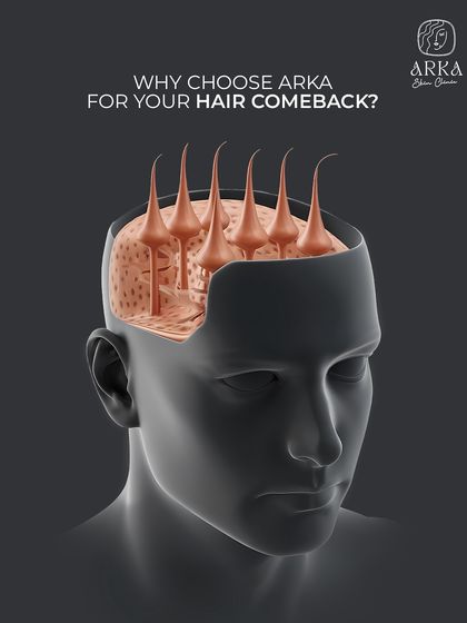 Why choose Arka for your hair comeback? This series highlights our personalized assessments, advanced techniques, expert-led team, and minimally invasive methods that ensure maximum comfort and results.