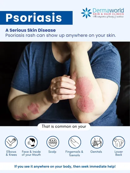 Psoriasis is more than just a rash; it's a serious skin disease that can appear on elbows, the scalp, and even nails. Understanding where it can show up is the first step toward seeking the immediate help needed to manage it effectively.