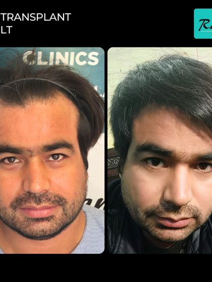 A great example of restoring a hairline for a patient with a broader forehead. The new hairline frames his face well and provides a much more youthful appearance.