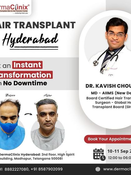 An announcement for my hair transplant consultations in Hyderabad, bringing my expertise to patients in different cities.