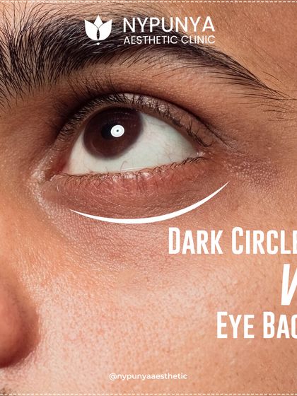 Dark circles versus eye bags. Many people confuse the two, but they have different causes and require different solutions.