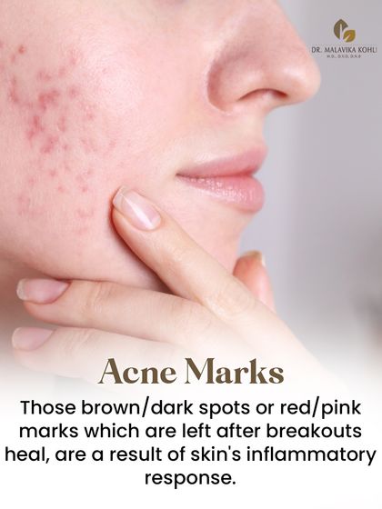 Post-inflammatory hyperpigmentation, or acne marks, are the dark or red spots left behind after a breakout heals. These are a result of the skin's inflammatory response, and their management is a key part of a complete acne treatment plan.