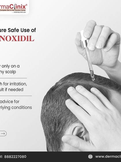 To ensure the safe use of Minoxidil, apply it only on a healthy scalp, watch for any irritation, and seek a doctor's advice to rule out underlying conditions.
