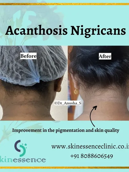This result shows the successful treatment of Acanthosis Nigricans, often mistaken for dirt on the neck. By identifying the underlying cause and using a combination of topical medication and laser sessions, we significantly lightened the pigmentation and improved skin quality.