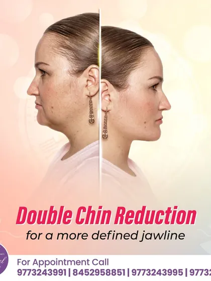 This before-and-after image showcases the effectiveness of our non-surgical Double Chin Reduction treatment. The procedure targets and reduces fat under the chin, resulting in a more defined and sculpted jawline.