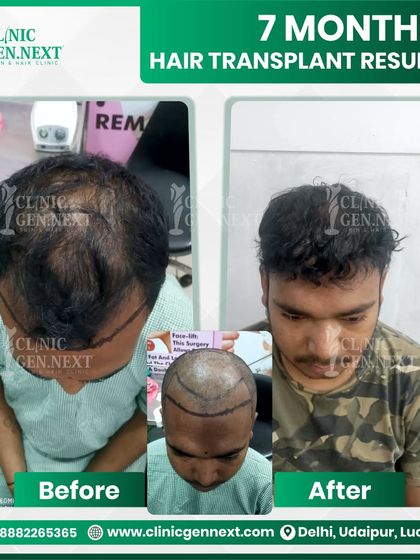 This is what visible growth looks like at the 7-month mark. The final density and texture will continue to improve for up to 12-14 months, but the progress here is already significant.