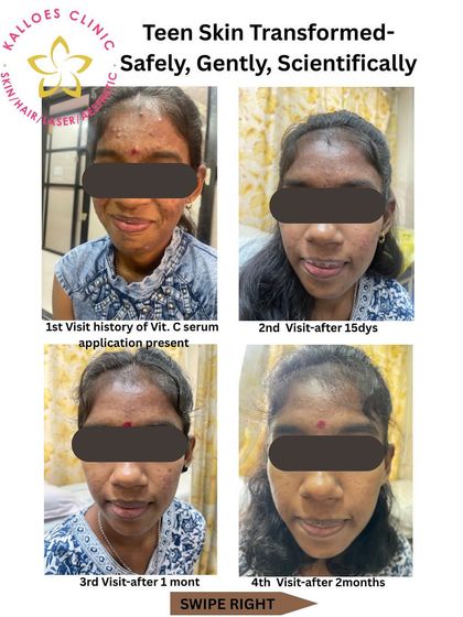 This is a real-life example of how a patient's skin can change with the right guidance. This young teen came to me after a bad reaction to an over-the-counter serum. With a gentle, medically-supervised routine, we calmed the inflammation and cleared her skin in just two months.
