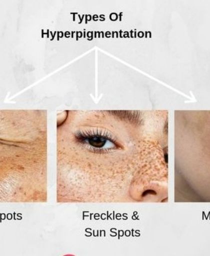 This graphic illustrates the three most common types of hyperpigmentation I see in my practice: age spots, freckles or sun spots, and melasma. Each is treated with a distinct and personalized protocol.