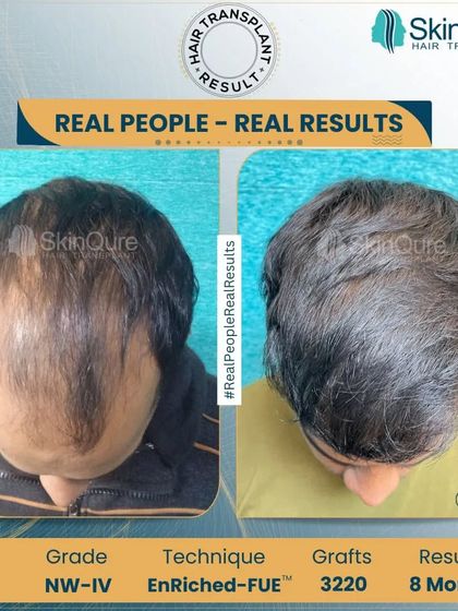 This top-down view shows the significant improvement in coverage and density 8 months after a corrective procedure. The patient, who had Norwood Grade 4 hair loss, now has a much fuller look thanks to the strategic placement of 3220 grafts.