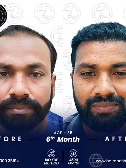 This 6-month result from a 4500-graft BIO FUE procedure shows a remarkable transformation and a very happy patient.