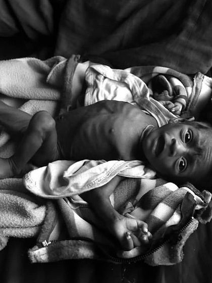 One of the most arresting photographs from the exhibition, showing the vulnerability of an infant affected by severe acute malnutrition. These images serve as a powerful call to action.