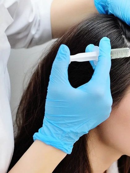 This is a close-up of the PRP injection process. It is a minimally invasive technique that delivers growth factors directly to the hair follicles to stimulate growth.