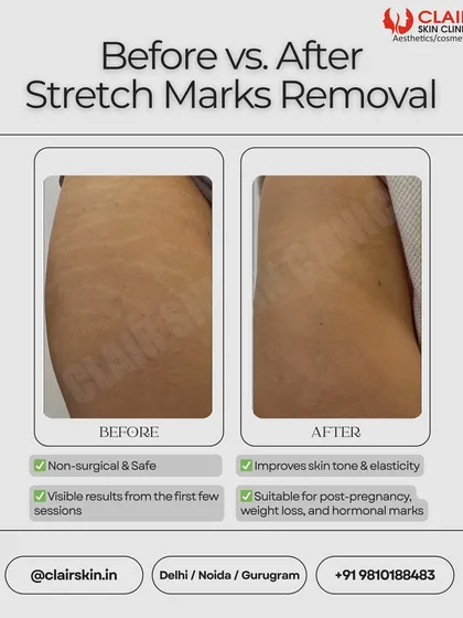 We help clients regain confidence by effectively treating stretch marks, whether they are from pregnancy, weight changes, or fitness. This before and after photo shows a significant improvement in the texture and visibility of stretch marks on the thigh after a course of our combination treatments.