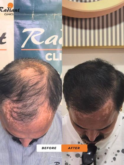This patient had advanced hair loss with some patches of vitiligo. The after photo shows a remarkable result with full coverage, proving that great outcomes are possible even in complex cases.