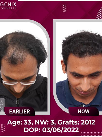 A 33-year-old's successful restoration from Grade 3 baldness with 2012 grafts.