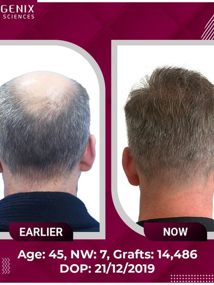 An incredible transformation of a 45-year-old international patient with Grade 7 baldness, who received 14,486 grafts for a full head of hair.