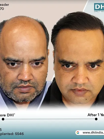 A frontal before and after of the same client one year post-transplant. The restored hairline and full, healthy hair have completely transformed his appearance and boosted his confidence.