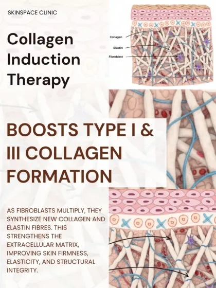 Microneedling is a form of Collagen Induction Therapy. As fibroblasts multiply, they synthesize new Type I and Type III collagen and elastin fibers. This strengthens the skin's extracellular matrix, improving firmness, elasticity, and structural integrity.