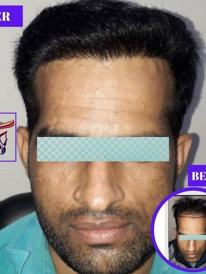 A frontal view of another successful hair transplant. The 'after' image on the left demonstrates how we craft a dense and age-appropriate hairline, completely transforming the client's appearance.