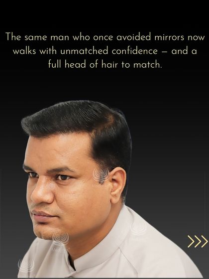 The same man who once avoided mirrors now walks with unmatched confidence and a full head of hair to match.