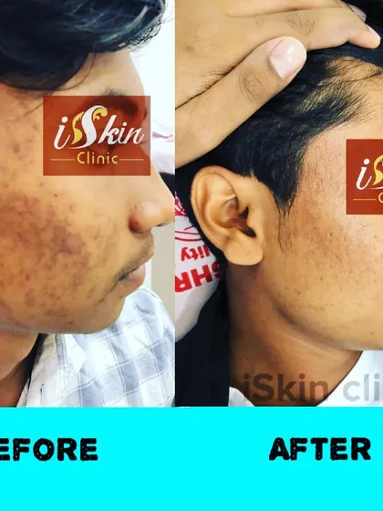 Here is a clear example of a successful transformation, showing the 'before' state with active acne and post-inflammatory hyperpigmentation, and the 'after' state with clearer skin. We create customized acne treatment plans to address both breakouts and resulting discoloration.
