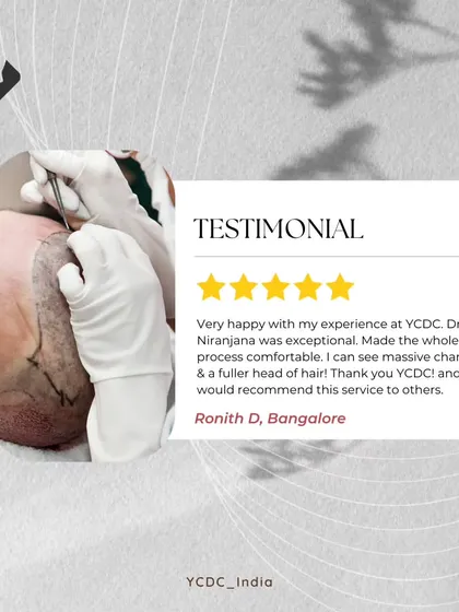 This patient describes his experience as "exceptional" and the process as "comfortable." Seeing massive changes and a fuller head of hair is the goal I strive for with every patient.