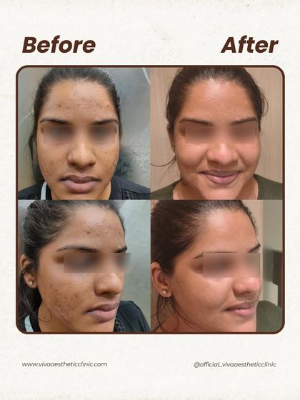 Here, the main concern was acne scarring and residual marks on the cheeks and forehead. Our plan focused on collagen-stimulating treatments to improve the texture and lift the scars, resulting in visibly smoother and healthier-looking skin.