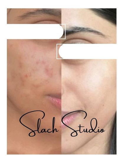 A powerful transformation for acne-prone skin, showing a reduction in both active acne and scarring.