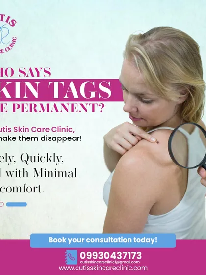 Skin tags are not permanent. At our clinic, we make them disappear safely and quickly with minimal discomfort, as our dermatologist examines a skin tag on a patient's shoulder with a magnifying glass.