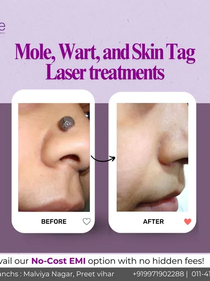 Our advanced laser treatments can safely and effectively remove moles, warts, and skin tags with precision. This before-and-after shows how we can help you achieve clear, smooth skin with minimal downtime.