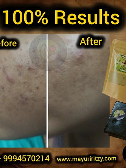 Another success story for my acne treatment. This customer's face shows a visible reduction in pimples and marks. I create these products to give you clear, healthy skin you can be confident in.