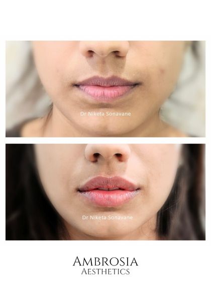 A beautiful, natural-looking lip enhancement. My focus was on defining the lip border and adding subtle volume for better hydration and shape, perfectly balancing the patient's facial features.