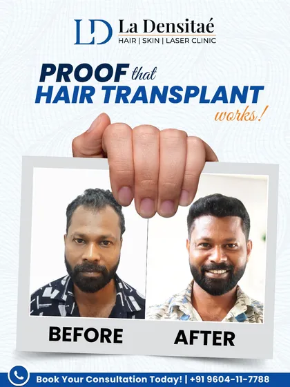 Still wondering if hair transplants work? Biju did too, until he got 2,700 grafts and saw the change for himself. This is medically-backed proof that a real, long-term solution is available.
