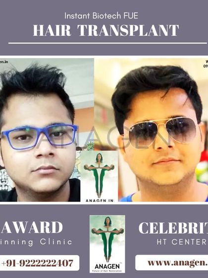 An excellent result from our Instant Biotech FUE hair transplant. The patient's new hairstyle looks great and completely natural.