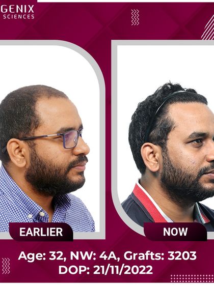 The top choice for natural restoration, this 32-year-old's Grade 4A hair loss was treated with 3203 grafts.